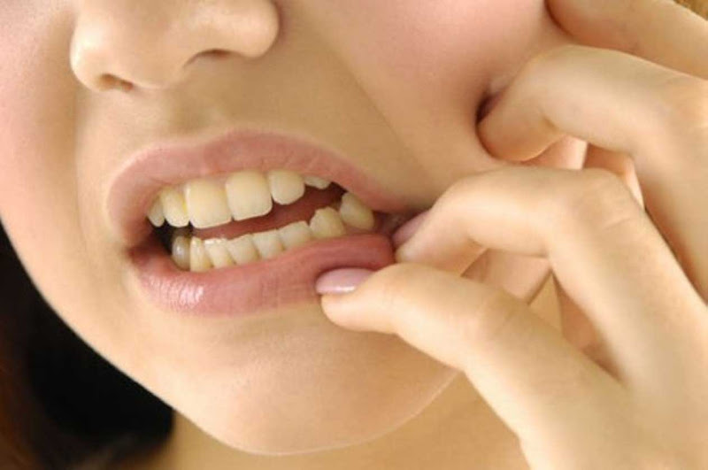 Viêm xương hàm hay bị bỏ qua do triệu chứng dễ nhầm với bệnh răng miệng thông thường- Ảnh 2.
