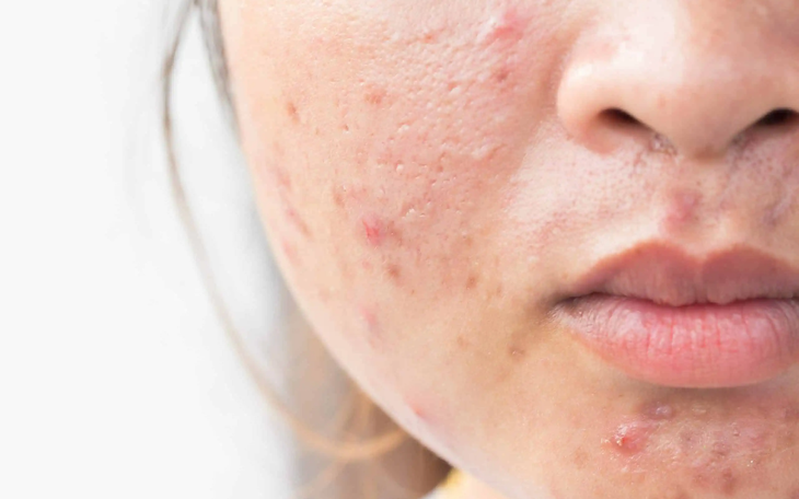 6 cách để ngăn ngừa mụn trứng cá trong kỳ kinh nguyệt - Ảnh 2.