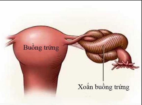 Cảnh Giác Với Xoắn U Nang Buồng Trứng: Dấu Hiệu và Biện Pháp Cứu Cánh