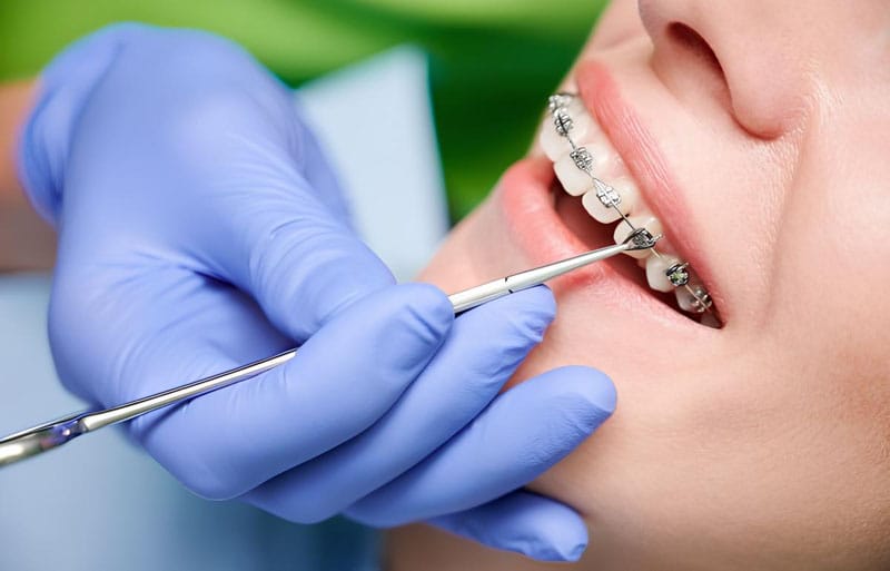 Giải Quyết Tình Trạng Hóp Má Khi Niềng Răng- Ảnh 2.