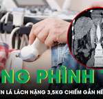 Câu Chuyện Cảnh Báo Sức Khỏe: Nam Sinh 18 Tuổi Bị Gan Nhiễm Mỡ Do Lối Sống Sai Lầm
