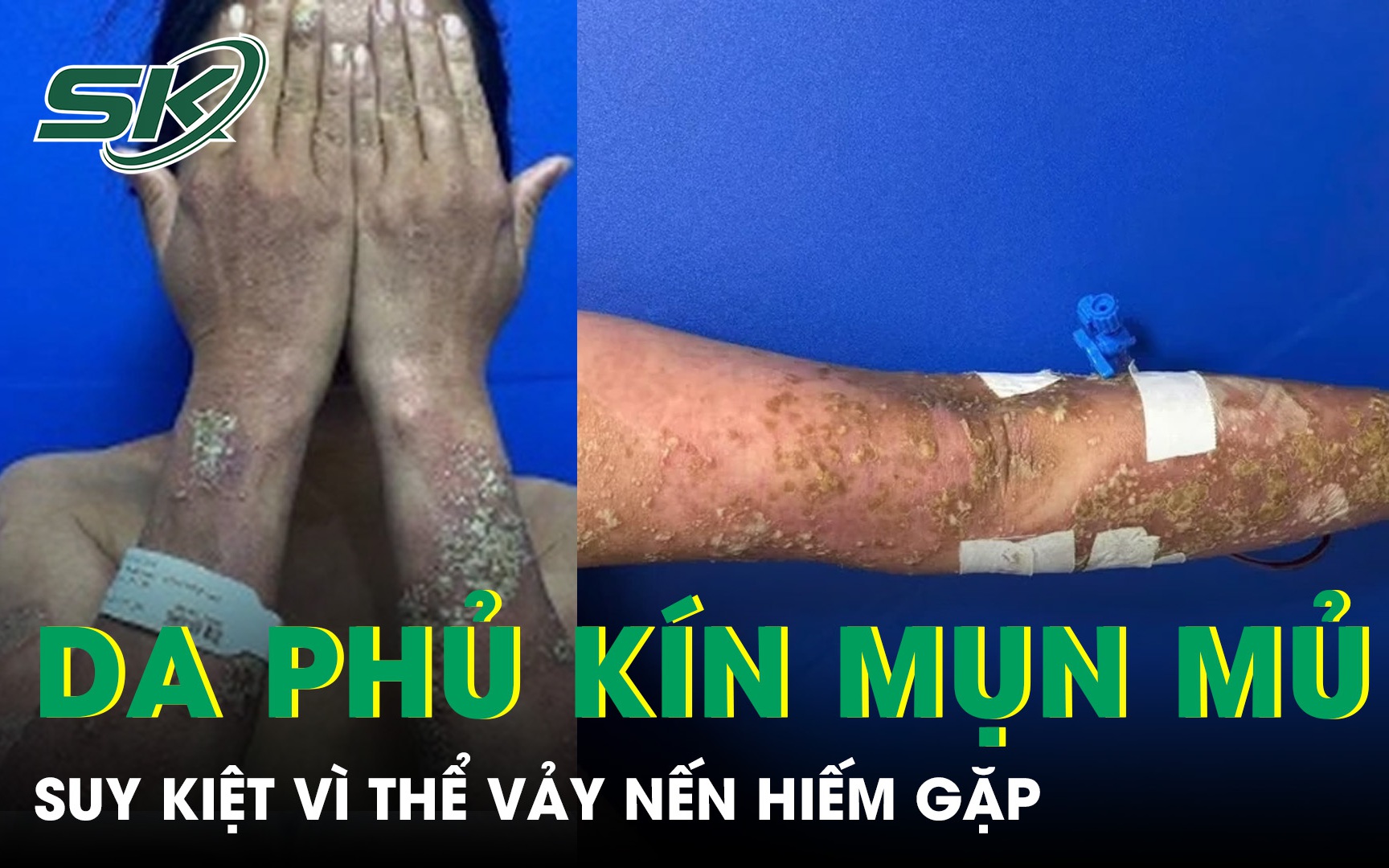 Nguy Hiểm Từ Việc Tự Ý Sử Dụng Thuốc Điều Trị Vảy Nến: Cảnh Báo Cần Thiết