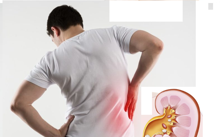 Sỏi tiết niệu ở trẻ: Nguy Cơ Và Cách Phòng Ngừa Hiệu Quả- Ảnh 1.