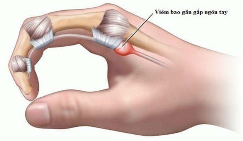 Cảnh Báo Viêm Gân Gấp Ngón Tay: Nhận Diện và Điều Trị Kịp Thời