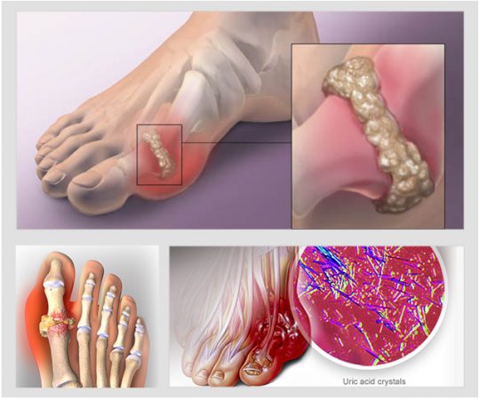 Tác Động Của Tăng Acid Uric Đến Sức Khỏe Nam Giới: Cần Biết Gì?