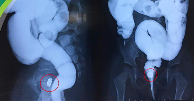 Bé Trai 5 Tuổi Nhét Viên Đạn Đồ Chơi Vào Hậu Môn: Hành Trình Cấp Cứu Và Những Điều Cần Biết