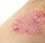 Những Điều Cần Biết Khi Nghi Ngờ Viêm Da Tiếp Xúc