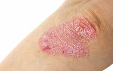 Những Điều Cần Biết Khi Nghi Ngờ Viêm Da Tiếp Xúc
