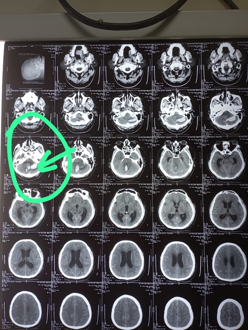 Hình ảnh phim chụp CT sọ não của thầy giáo Nguyễn Hoàng Phương.