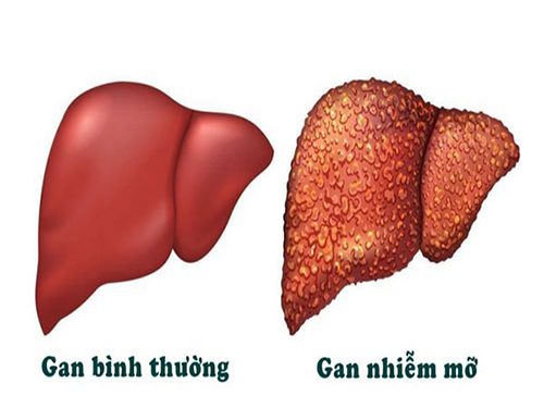 Các xét nghiệm cần làm để kiểm tra, đánh giá mức độ gan nhiễm mỡ- Ảnh 1.