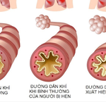 Những Dấu Hiệu Cần Theo Dõi Khi Trẻ Sặc Nước: Cách Ứng Phó Khẩn Cấp