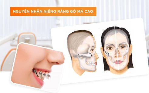 Giải Quyết Tình Trạng Hóp Má Khi Niềng Răng: Nguyên Nhân và Giải Pháp Hiệu Quả