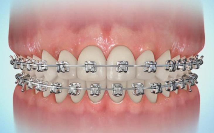 Giải Quyết Tình Trạng Hóp Má Khi Niềng Răng- Ảnh 1.