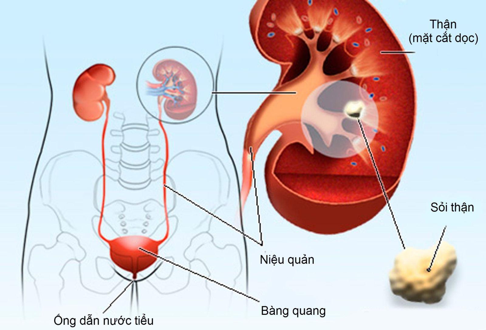 Sỏi tiết niệu ở trẻ: Nguy Cơ Và Cách Phòng Ngừa Hiệu Quả- Ảnh 2.