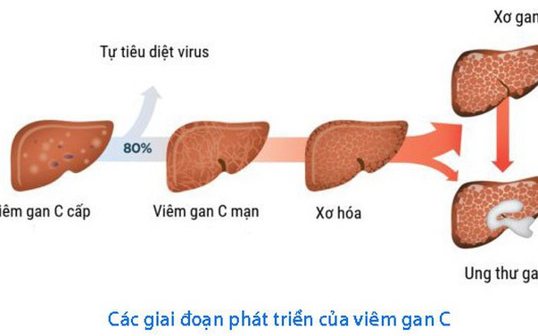 Lộ Trình Đến Năm 2030: Giải Quyết Vấn Đề Viêm Gan Virus Tại Việt Nam