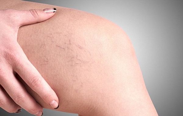 3 biến chứng nguy hiểm khi bị suy giãn tĩnh mạch chân- Ảnh 1.