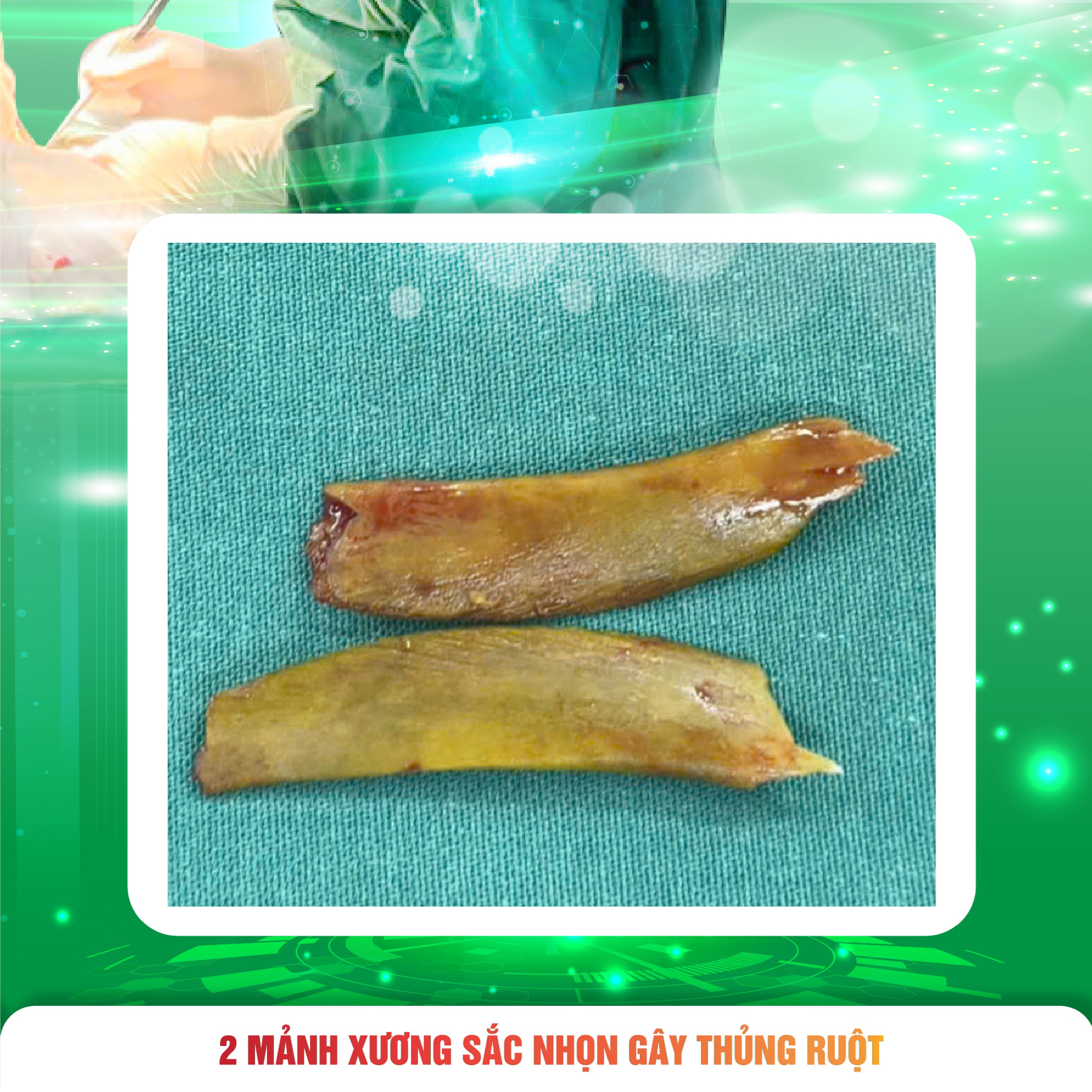 Nguy Hiểm Khi Nuốt Phải Xương Nguy Hiểm Khi Nuốt Phải Xương