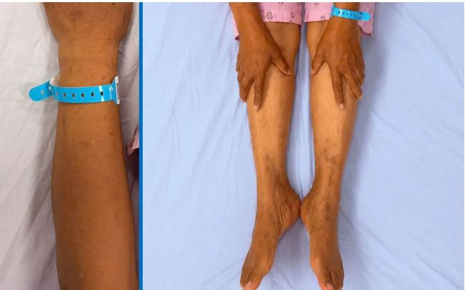 Nhận Biết Sớm Các Dấu Hiệu Tổn Thương Gan Để Bảo Vệ Sức Khỏe