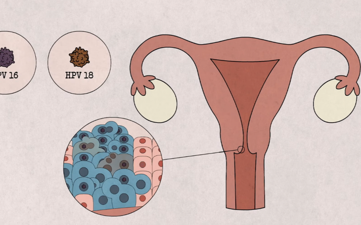 Tại Sao Phụ Nữ Vẫn Cần Khám Tầm Soát Ung Thư Cổ Tử Cung Sau Khi Tiêm HPV?