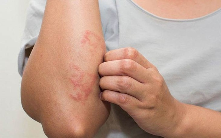 Giải Pháp Kiểm Soát Viêm Da Cơ Địa và Phòng Ngừa Tái Phát Hiệu Quả - Ảnh 1.