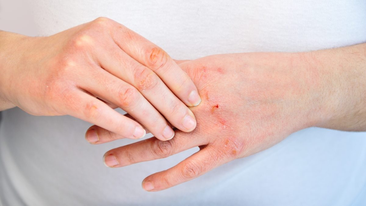 Giải Pháp Kiểm Soát Viêm Da Cơ Địa và Phòng Ngừa Tái Phát Hiệu Quả - Ảnh 2.